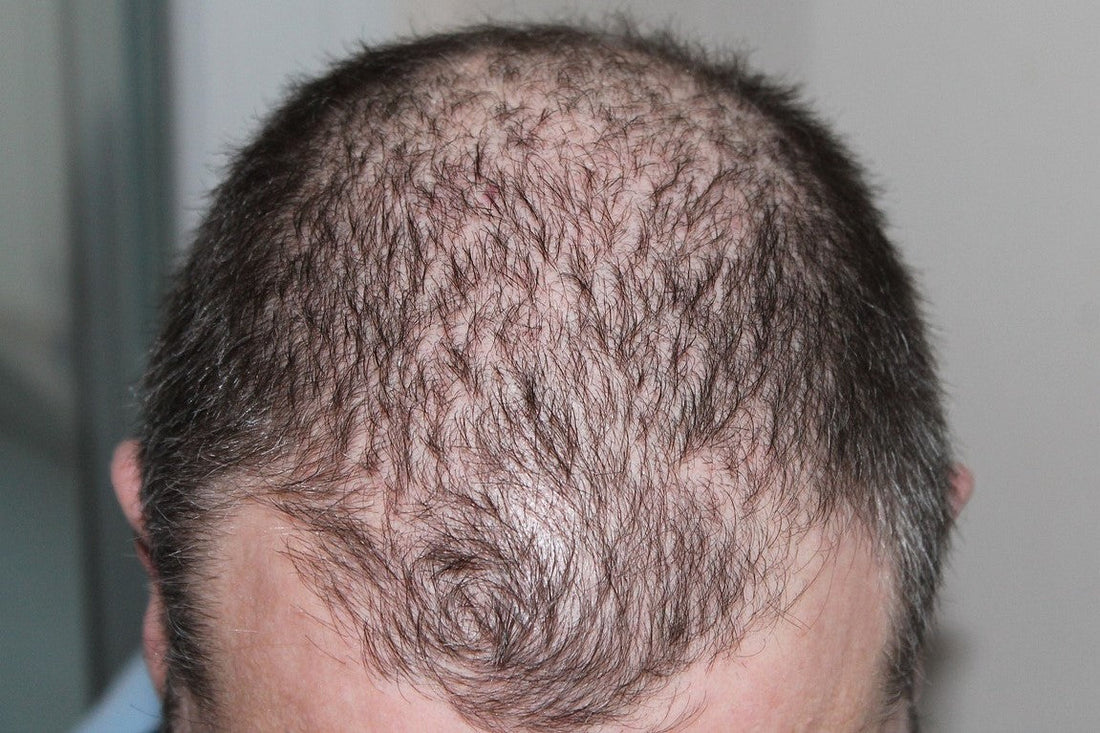 Close-up of a man with thinning hair and bald patches on the top of his head, showing signs of male pattern baldness.