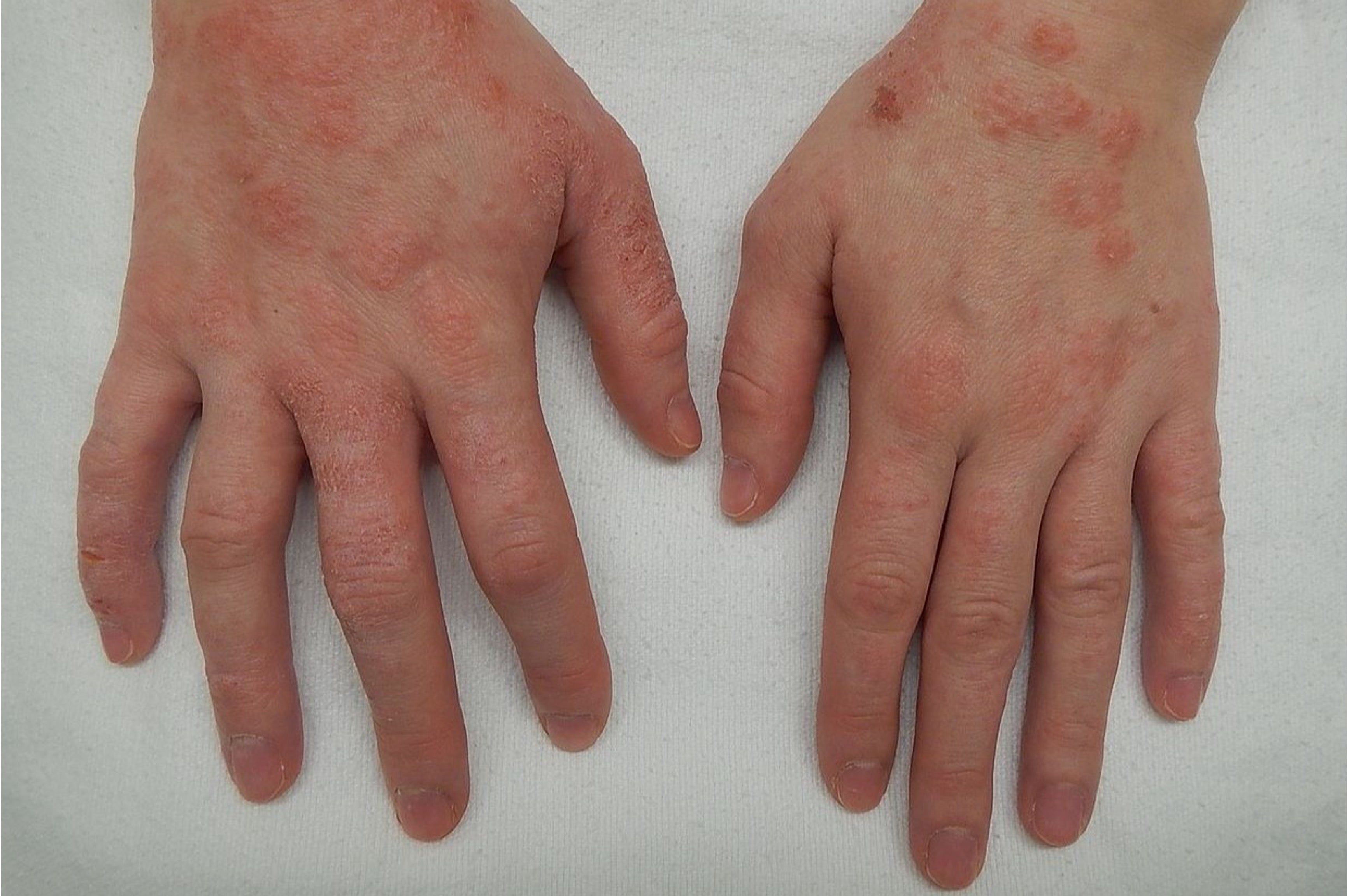 Is Shilajit Good for Eczema?