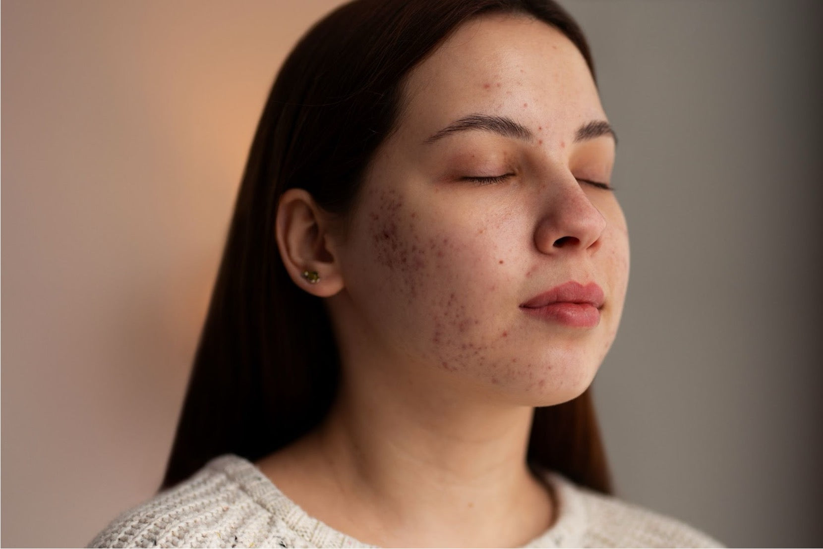 Is Shilajit Good for Acne Scars?