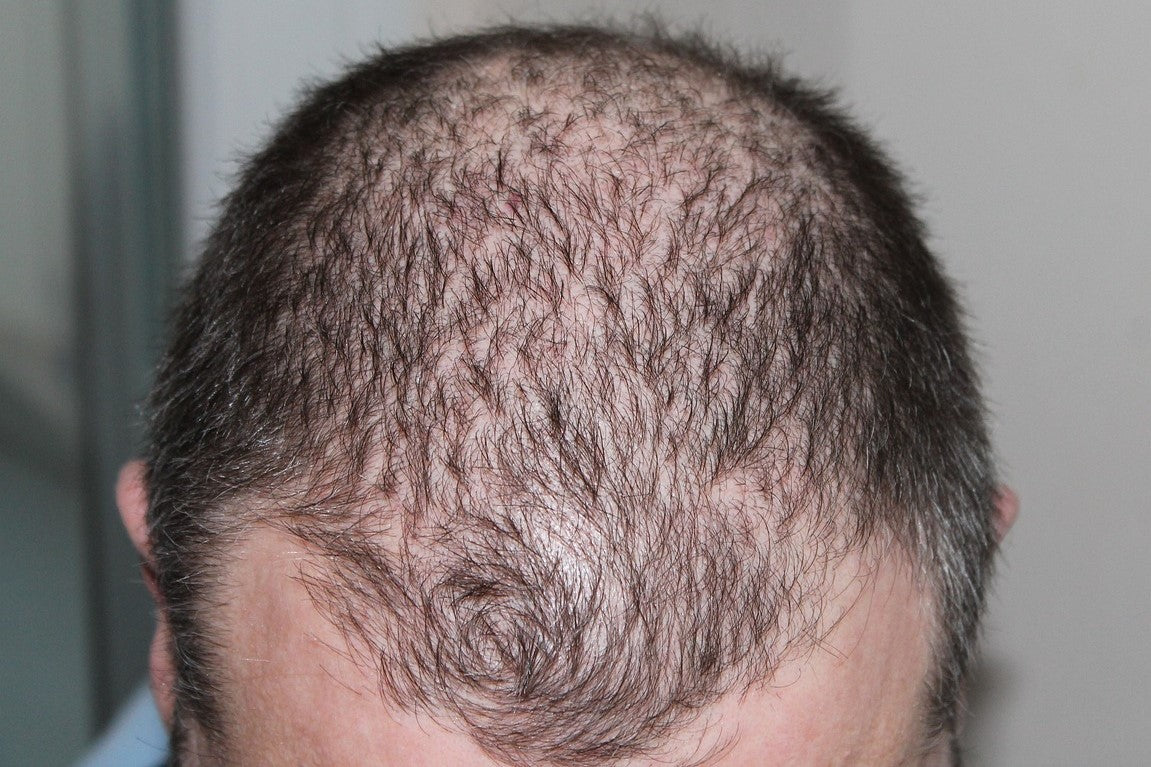 Close-up of a man with thinning hair and bald patches on the top of his head, showing signs of male pattern baldness.