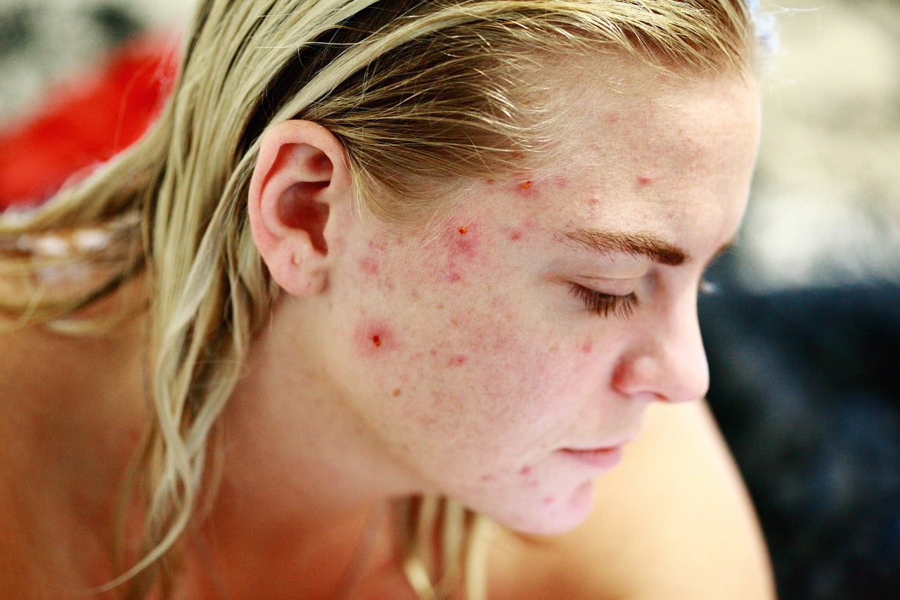 Close-up of a woman with acne, showing several red blemishes and breakouts on her cheek and jawline.
