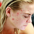 Shilajit for Acne: Can It Prevent Breakouts?
