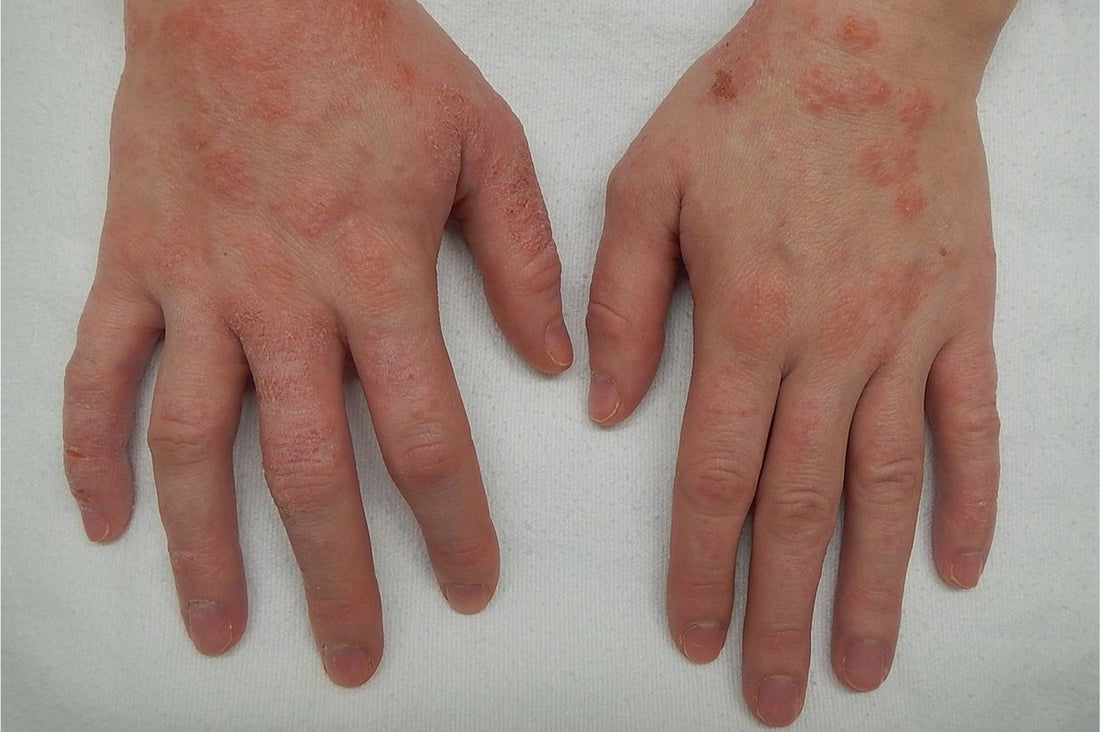 Is Shilajit Good for Eczema?