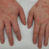 Is Shilajit Good for Eczema?