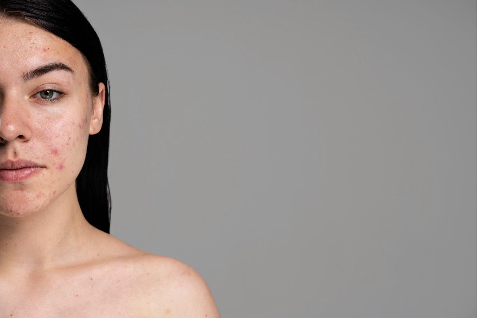 Is Shilajit Good for Hormonal Acne?